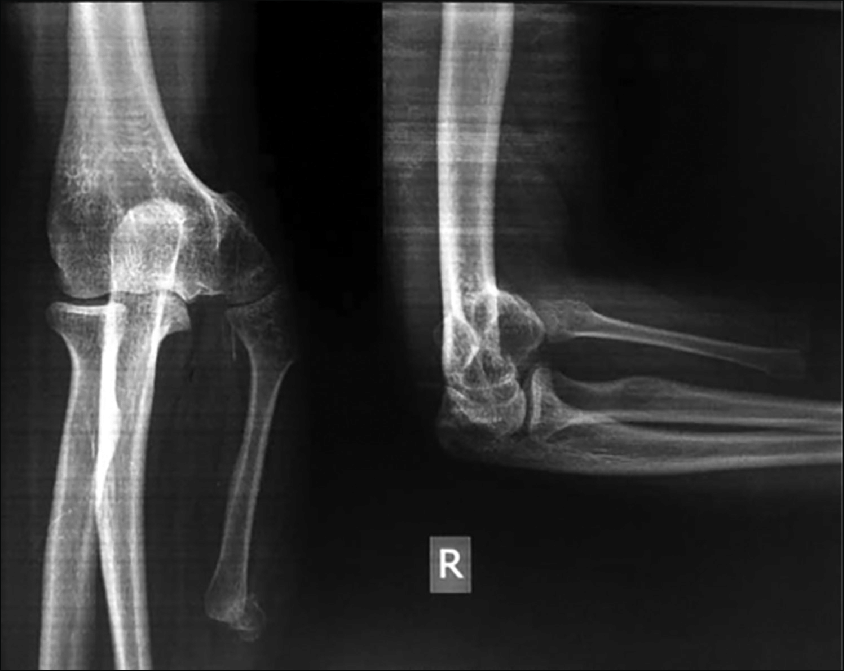 Ncct Right Elbow Joint In DLF Phase 3