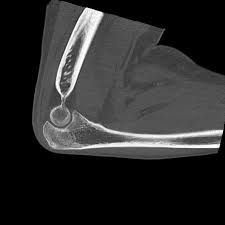 Ncct Right Elbow Joint 3d In DLF Phase 2