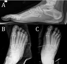 Ncct Right Heel 3d In Gurugram Sector 38