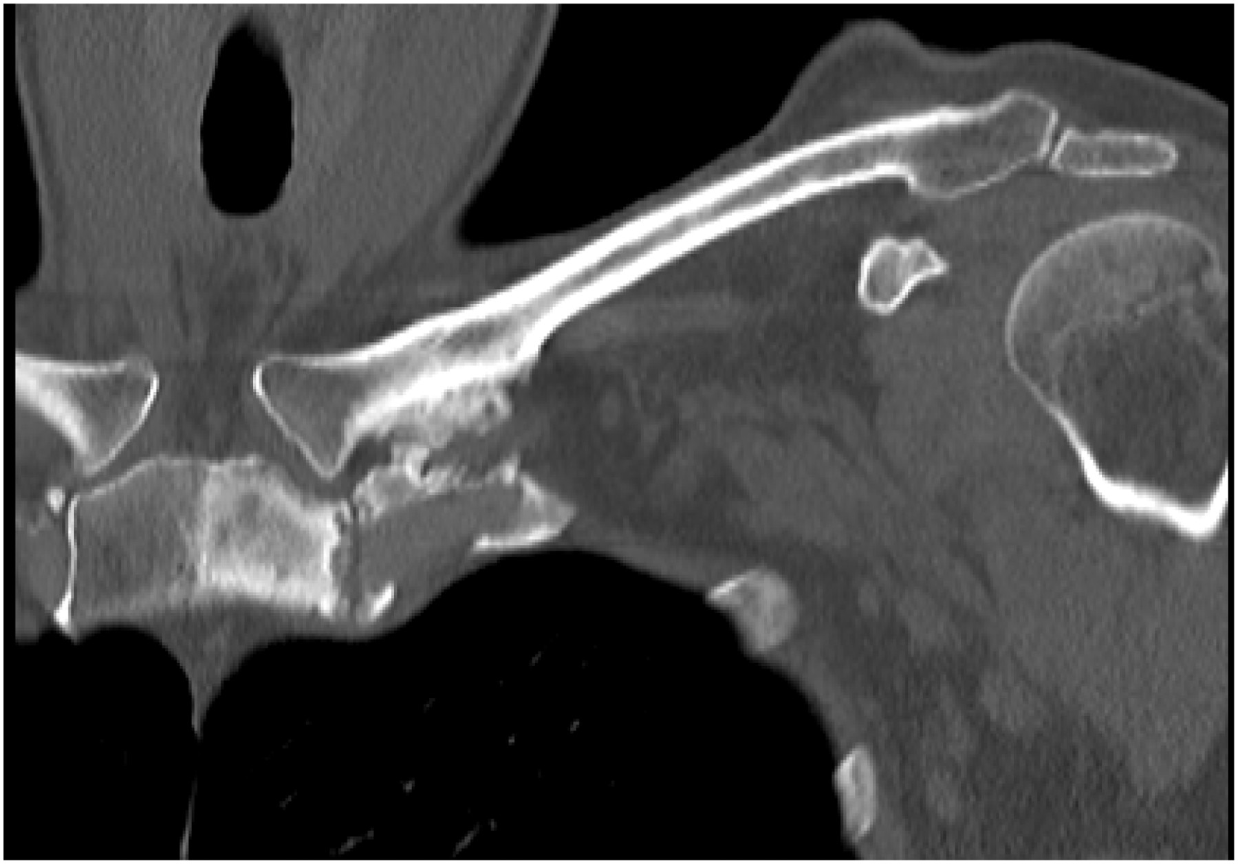 Ncct Right Steno-Clavicle Joint In DLF Phase 3