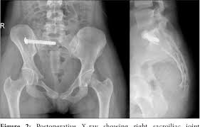 NCCT Sacrococcygeal Joint In Gurugram Sector 38