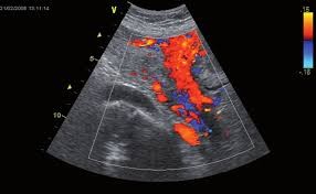 Colour Doppler B/L IleoFermoral Vessel In DLF Phase 3