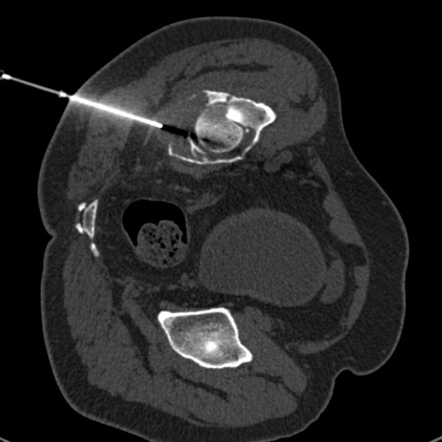 Ct Guide Bone Biopsy [M] In DLF Phase 3