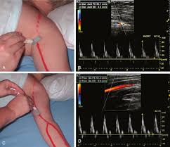 Doppler Arterial Upper Limb Bilateral In DLF Phase 3