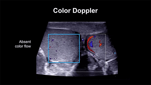 Scrotal Ultrasound With Doppler In Gurugram Sector 38