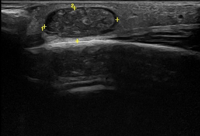 Small Part Ultrasound With Doppler In DLF Phase 3