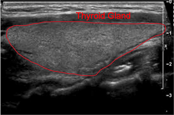 Thyroid Ultrasound In DLF Phase 2