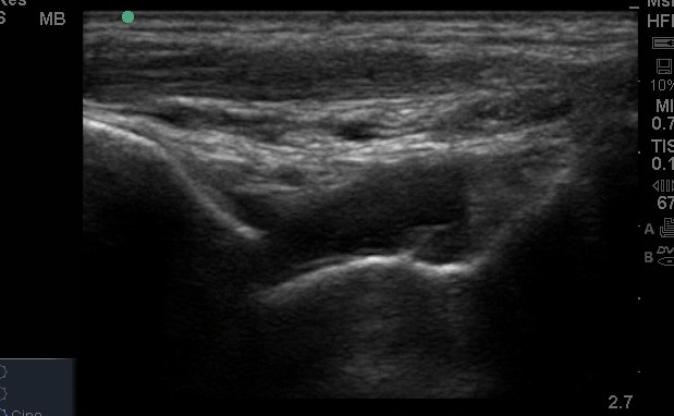 USG Ankle Joint Right In DLF Phase 3