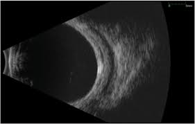 USG B Scan Left Eye In DLF Phase 3