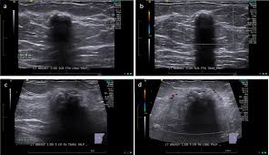 USG Breast Right Side In DLF Phase 3