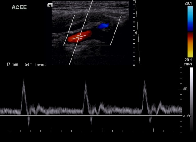 USG Carotid Doppler Normal In DLF Phase 2