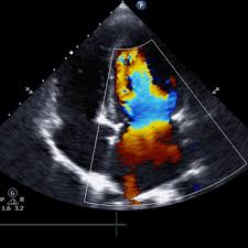 USG Doppler -Renal In DLF Phase 3