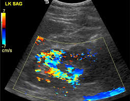 USG Doppler -Venous-Ul Bilateral In DLF Phase 3