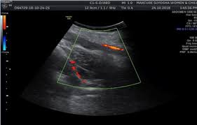 USG Doppler -Venous-Upper Limb Right In DLF Phase 2