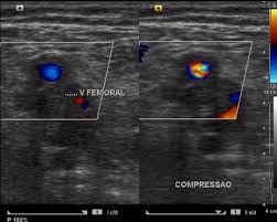 USG Doppler Arterial & Venous Lower Limb Right In DLF Phase 3