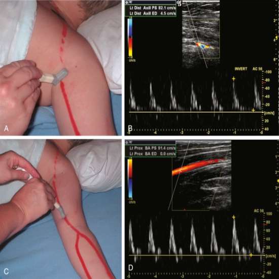 USG Doppler Arterial & Venous Upper Limb Left In Gurugram Sector 38