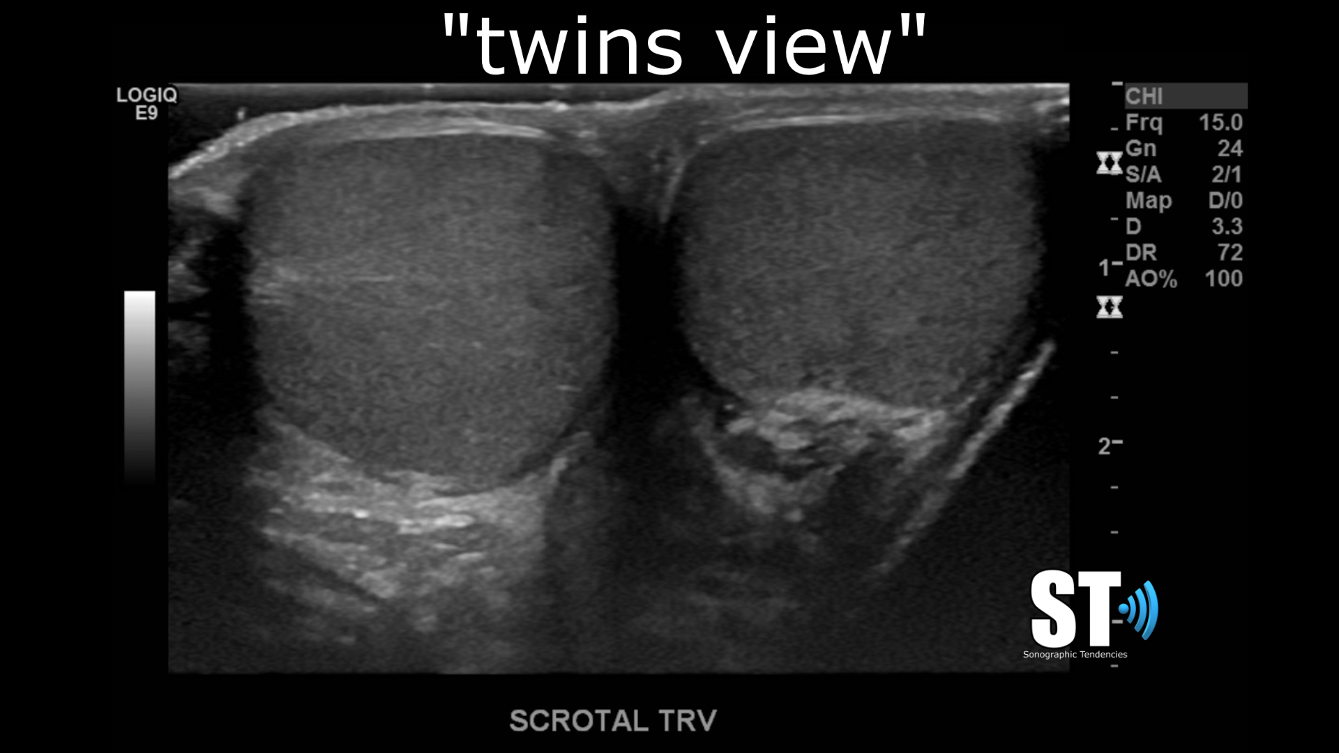 USG Doppler Scrotum In DLF Phase 3