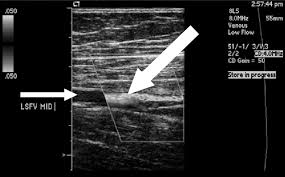 USG Doppler Venous Lower Limb Left In DLF Phase 2