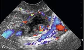 USG Doppler-Pelvis In DLF Phase 2