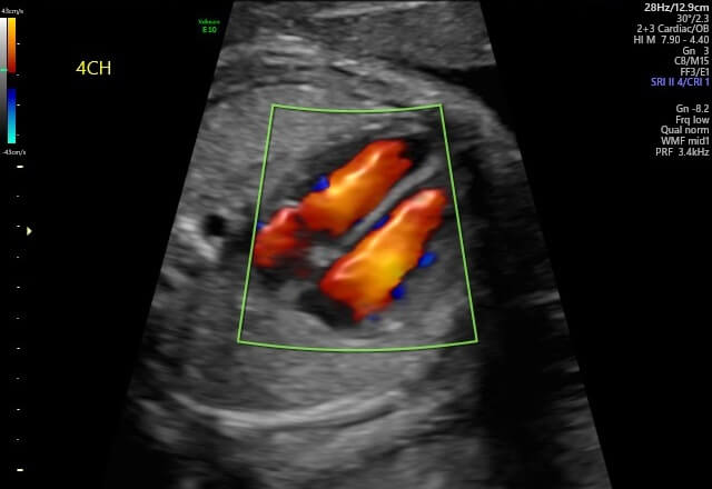 USGFetal Echocardiography In DLF Phase 3