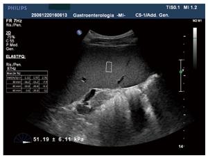 USGFibroscan Spleen In DLF Phase 3