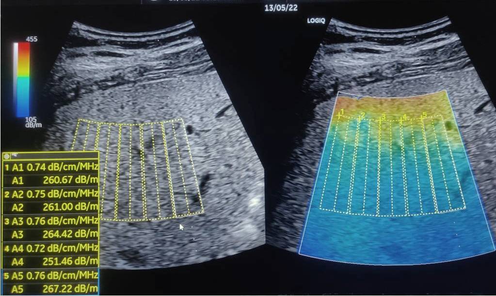 USGFibroscan With Cap In DLF Phase 2