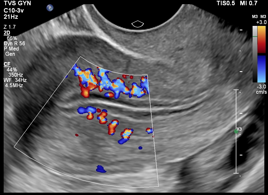 USG Follicular Study In DLF Phase 2