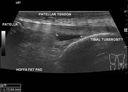 USG Knee Joint Right In DLF Phase 3