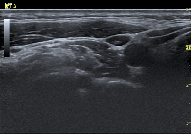 USG Neck In DLF Phase 3