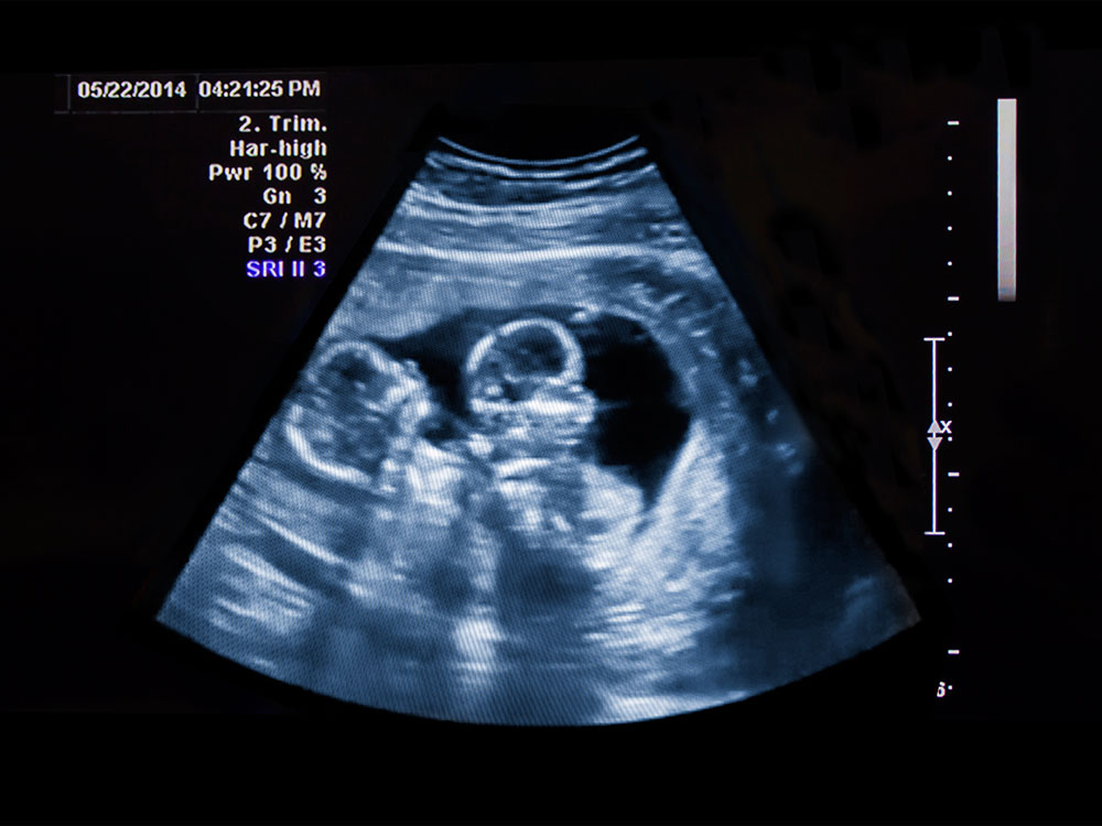 USGOBS-Twin Growth Scan In DLF Phase 2