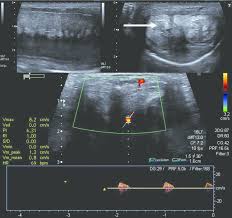 USG Penile Doppler Without Medicine In Gurugram Sector 38