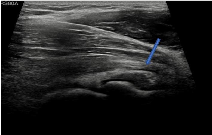 USG Right Forearm In DLF Phase 3