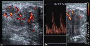 USG Soft Tissue Colour Doppler In DLF Phase 3