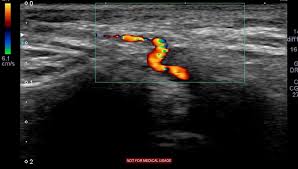 USG Temporal Arterial Doppler B/L In DLF Phase 3