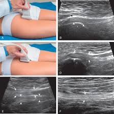 USG Thigh Right In DLF Phase 3