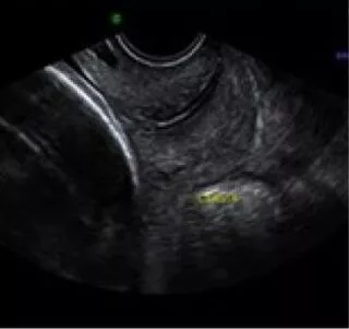 USGTVS/Cervical Length Screening In DLF Phase 2